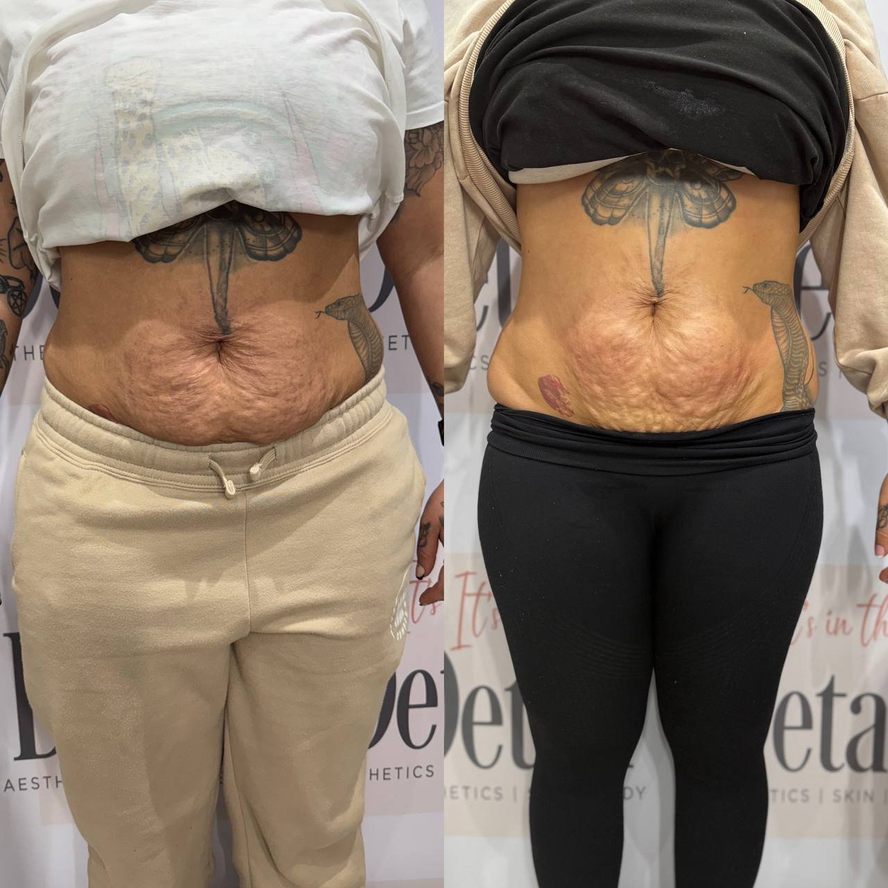 Tummy Sculpting Process